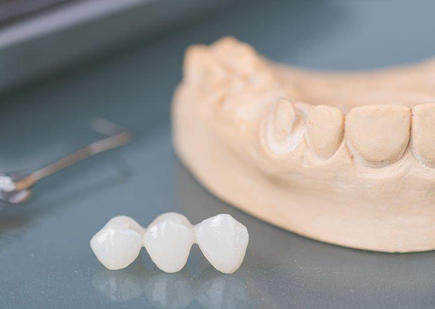 Emax restorations placeholder