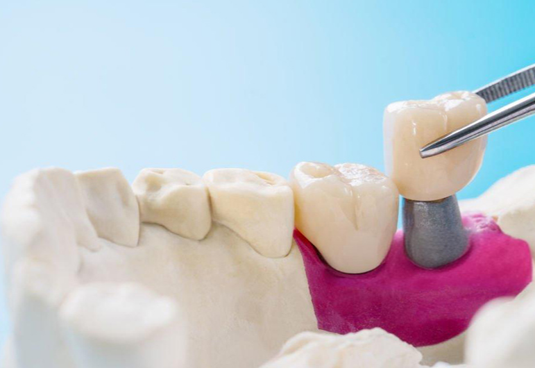 Balancing Tradition and Technology: Deyu Dental Highlights Expertise in PFM and Zirconia Crowns